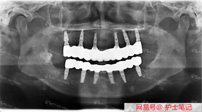 看似没缺几颗牙实际上无法正常吃饭全口牙松动难题如何解决？(图3)