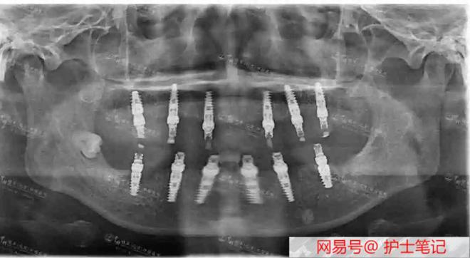 看似没缺几颗牙实际上无法正常吃饭全口牙松动难题如何解决？(图1)